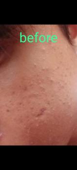 Product Review of CREAM TOTOL CABERAWIT (JERAWAT,FLEK,BEKAS JERAWAT) from T**o 0