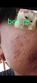 Product Review of CREAM TOTOL CABERAWIT (JERAWAT,FLEK,BEKAS JERAWAT) from T**o 1