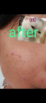 Product Review of CREAM TOTOL CABERAWIT (JERAWAT,FLEK,BEKAS JERAWAT) from T**o 2